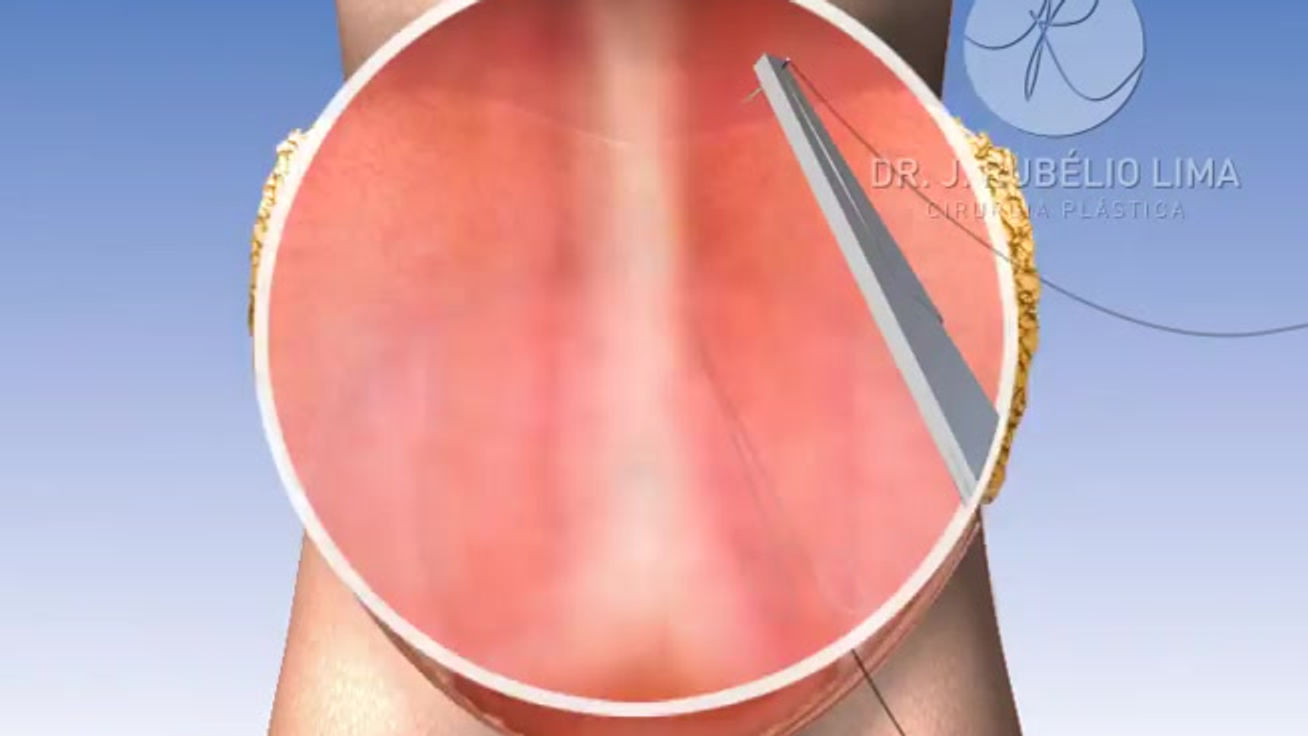 Abdominoplastia